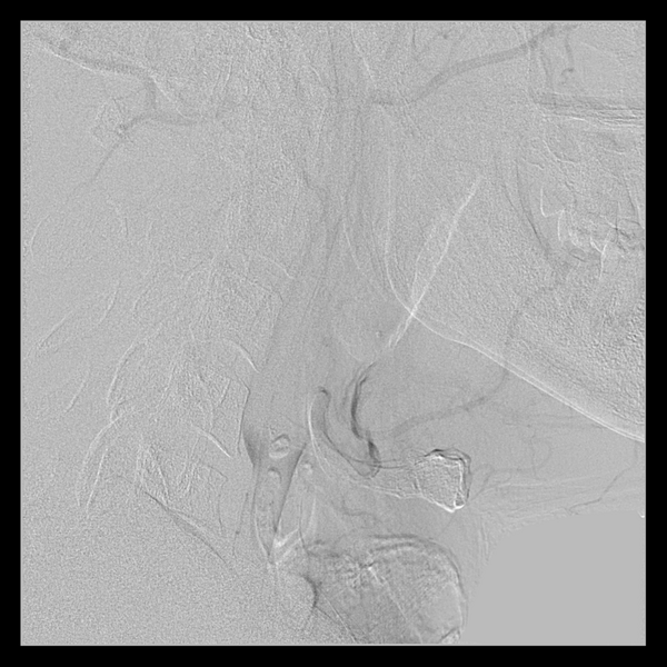 File:Cerebral arteriovenous malformation (Spetzler-Martin grade 2) (Radiopaedia 41262-44097 B 14).png