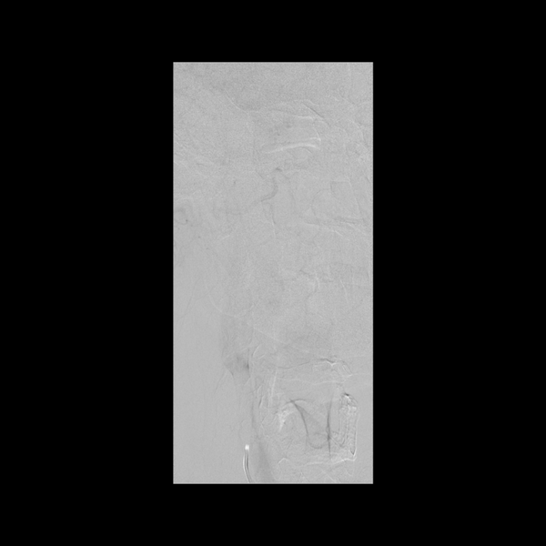 File:Cerebral arteriovenous malformation (Spetzler-Martin grade 2) (Radiopaedia 41262-44097 RT CCA NECK 14).png