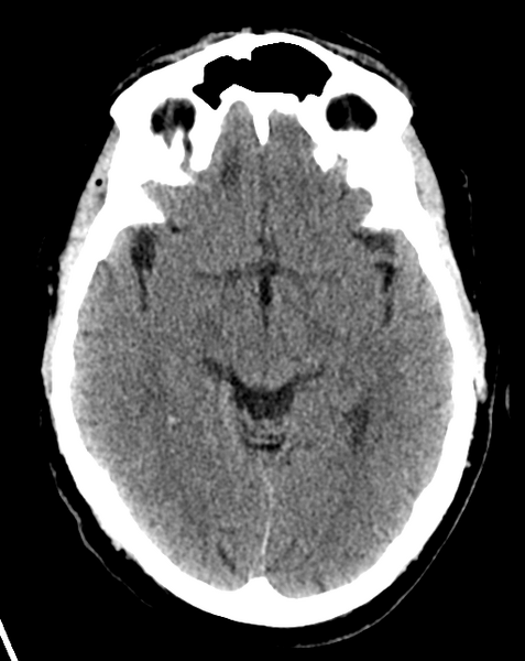 File:Cerebral embolic infarcts (embolic shower) (Radiopaedia 57395-64341 Axial non-contrast 14).png