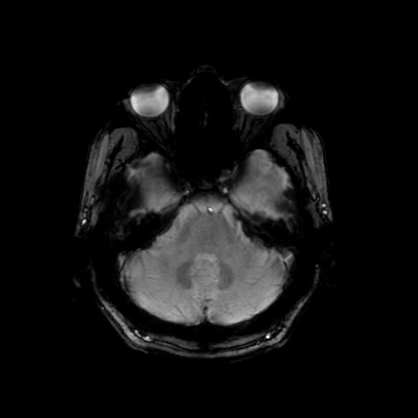Cerebral paragonimiasis (Radiopaedia 73473-84238 Axial SWI 19).jpg