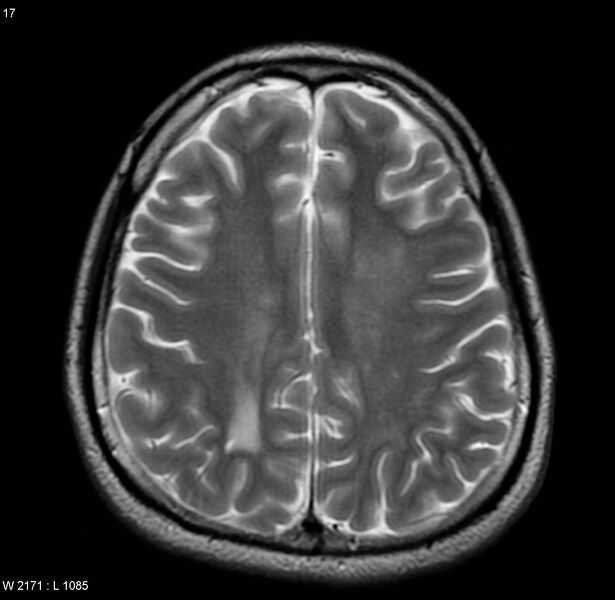 File:Cerebral vasculitis (Radiopaedia 5131-6923 Axial T2 8).jpg