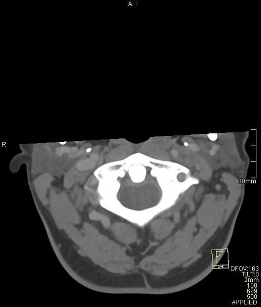 File:Cerebral venous sinus thrombosis (Radiopaedia 91329-108965 Axial venogram 4).jpg