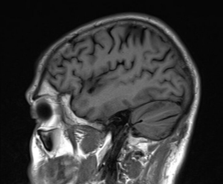 File:Cerebral venous thrombosis (Radiopaedia 71207-81504 Sagittal T1 6).jpg