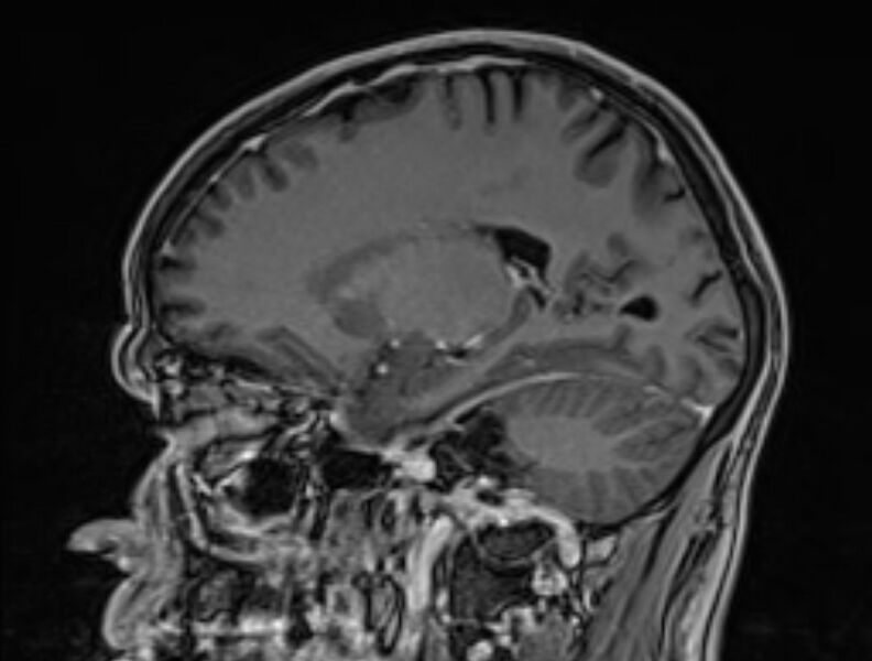 File:Cerebral venous thrombosis (Radiopaedia 71207-81504 Sagittal T1 C+ 40).jpg