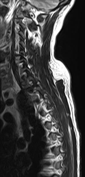 File:Cervical compressive myelopathy (Radiopaedia 71956-82411 Sagittal T2 4).jpg