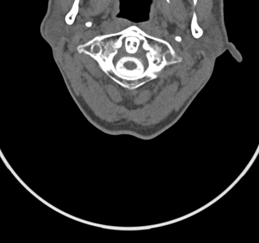 Cervical dural CSF leak on MRI and CT treated by blood patch (Radiopaedia 49748-54996 B 11).png