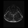 Cervical vertebrae metastasis (Radiopaedia 78814-91667 Axial T2 7).png