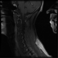 Cervical vertebrae metastasis (Radiopaedia 78814-91667 G 5).png