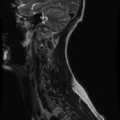 Cervical vertebrae metastasis (Radiopaedia 78814-91667 Sagittal T2 12).png