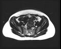 Cesarean section scar endometrioma (Radiopaedia 56569-63297 Axial T1 15).jpg