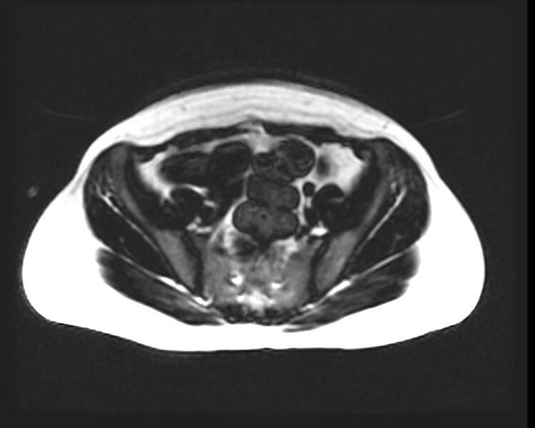 File:Cesarean section scar endometrioma (Radiopaedia 56569-63297 Axial T1 15).jpg