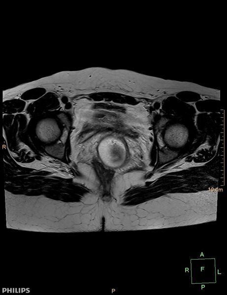 File:Cesarian scar endometriosis (Radiopaedia 68495-78066 Axial T2 18).jpg