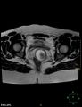 Cesarian scar endometriosis (Radiopaedia 68495-78066 Axial T2 18).jpg