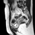 Cesarian section scar endometriosis (Radiopaedia 66520-75799 Sagittal T2 5).jpg