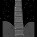 Chance fracture (Radiopaedia 36521-38081 Coronal bone window 25).jpg