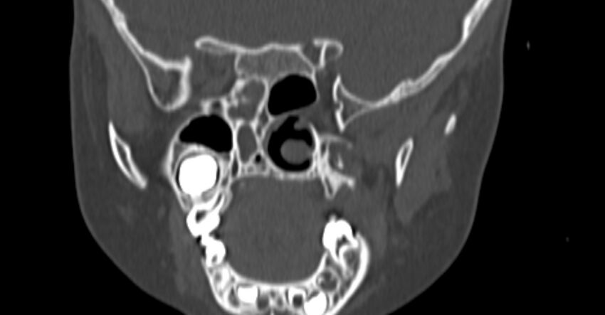 Choanal atresia (Radiopaedia 51295-56972 Coronal bone window 64).jpg