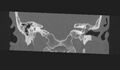 Cholesteatoma (Radiopaedia 10742-11203 Coronal bone window 14).jpg