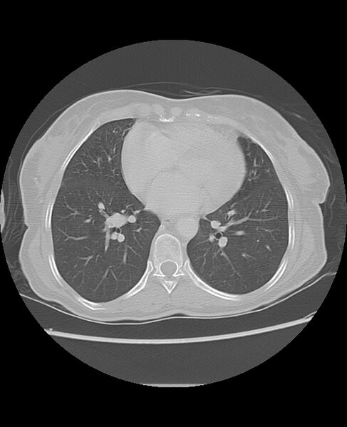 File:Chondrosarcoma (Radiopaedia 79427-92532 Axial lung window 36).jpg