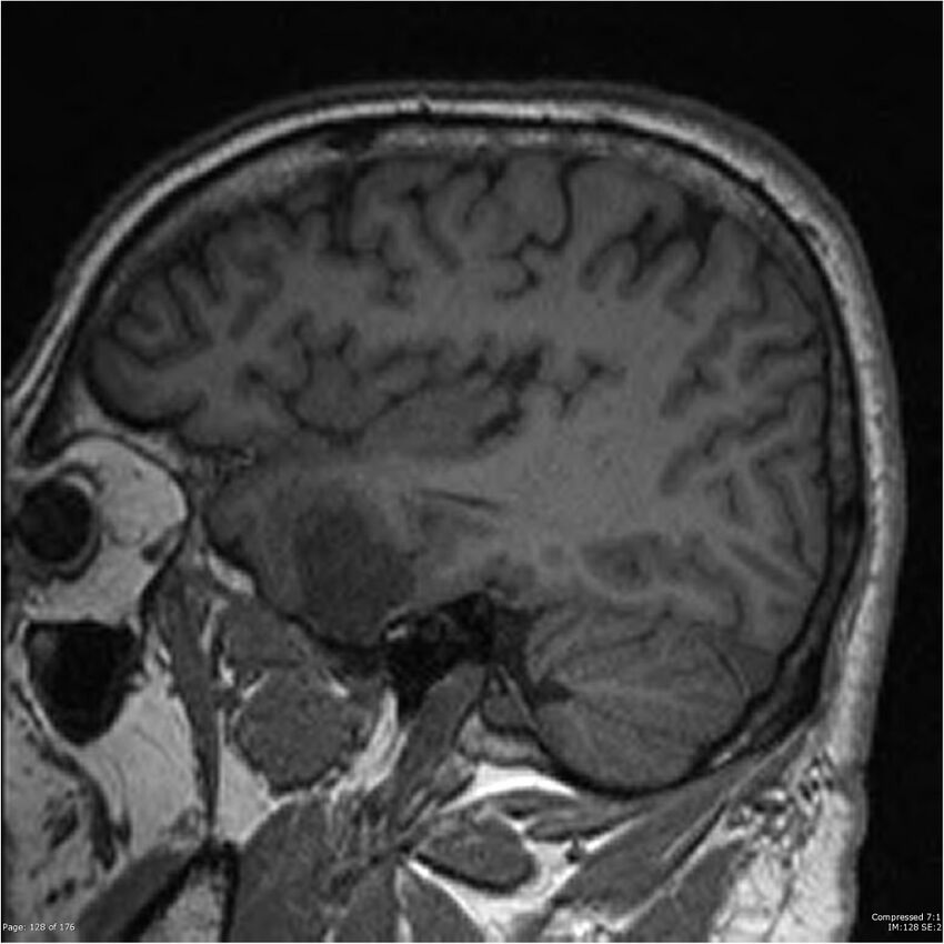 Chondrosarcoma of skull base- grade II (Radiopaedia 40948-43654 Sagittal T1 51).jpg