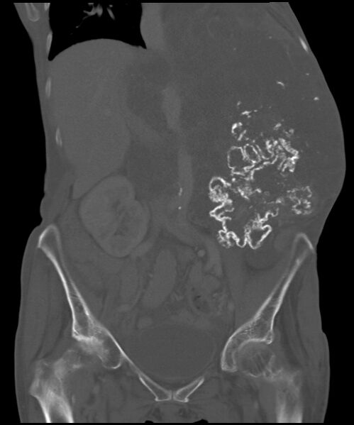File:Chondrosarcoma of the spine (Radiopaedia 49871-55143 Coronal bone window 19).jpg