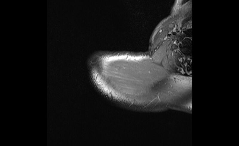 File:Choriocarcinoma in the shoulder (Radiopaedia 28603-28861 Axial T1 C+ fat sat 1).jpg