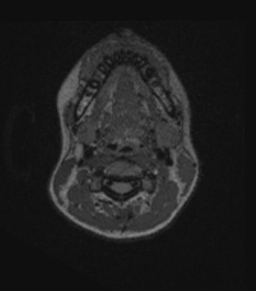 File:Choroid plexus carcinoma (Radiopaedia 91013-108553 Axial FLAIR C+ 26).jpg