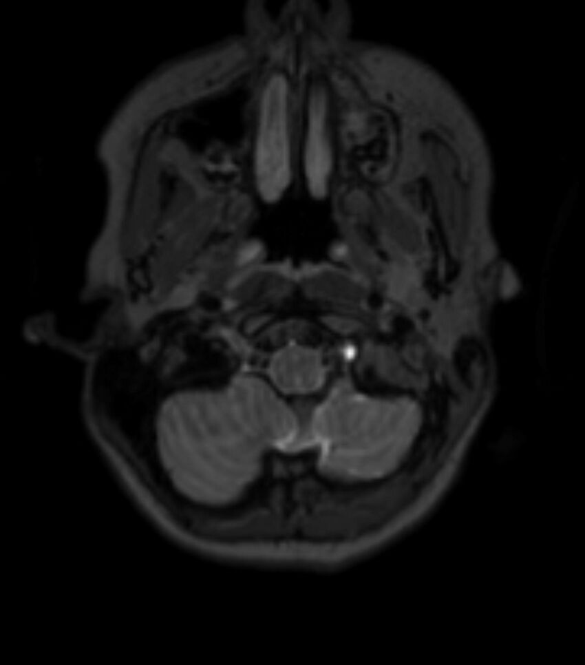 Choroid plexus carcinoma (Radiopaedia 91013-108553 Axial T2 fat sat 32).jpg