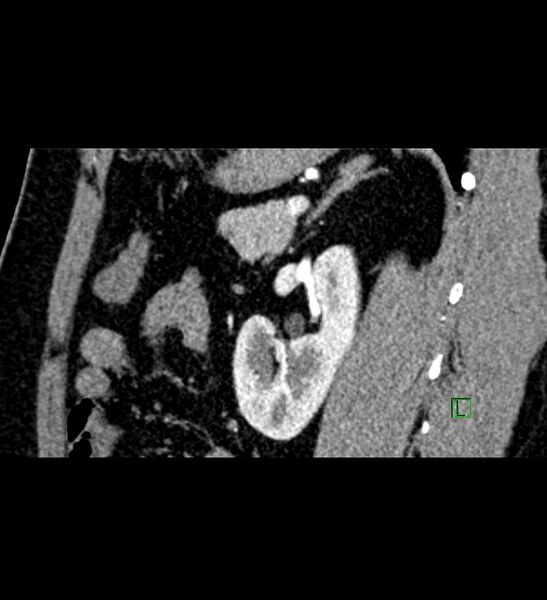 File:Chromophobe renal cell carcinoma (Radiopaedia 84286-99573 F 57).jpg