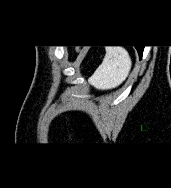 File:Chromophobe renal cell carcinoma (Radiopaedia 84286-99573 F 6).jpg