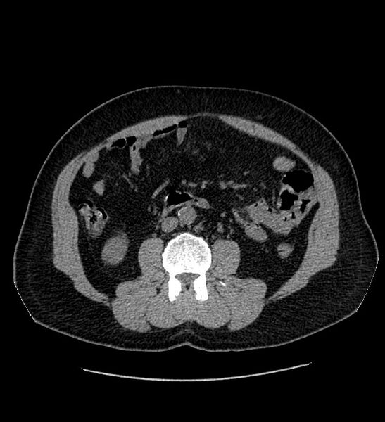 File:Chromophobe renal cell carcinoma (Radiopaedia 84337-99693 Axial non-contrast 74).jpg