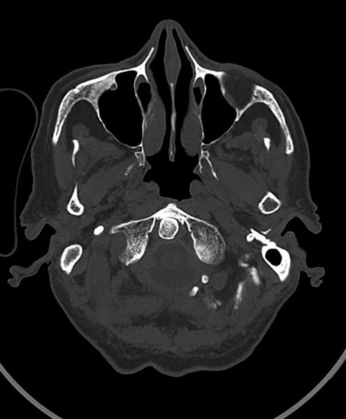 File:Chronic bilateral subdural hygroma (Radiopaedia 85801-101623 Axial bone window 108).jpg