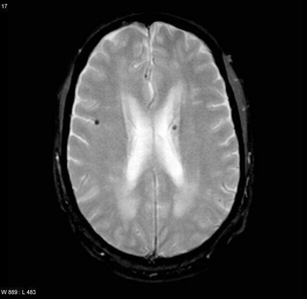 File:Chronic hypertensive encephalopathy (Radiopaedia 4564-6686 Axial Gradient Echo 12).jpg