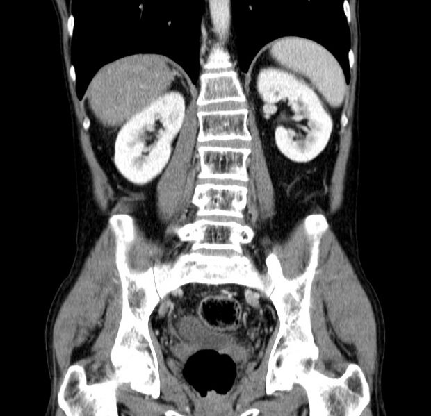 File:Chronic pancreatitis (Radiopaedia 23132-23172 C 41).jpg