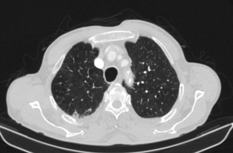 File:Chronic pulmonary embolism (Radiopaedia 91241-108843 Axial lung window 18).jpg