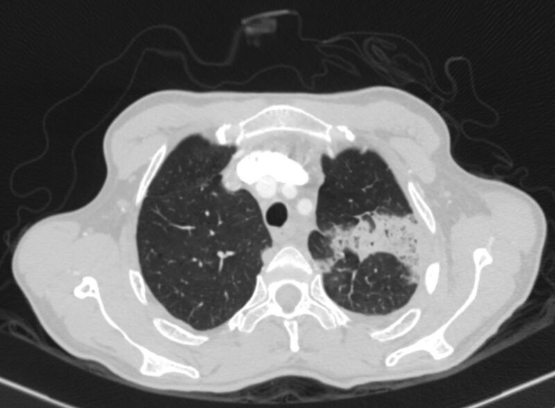 File:Chronic pulmonary embolism with bubbly consolidation (Radiopaedia 91248-108850 Axial lung window 29).jpg