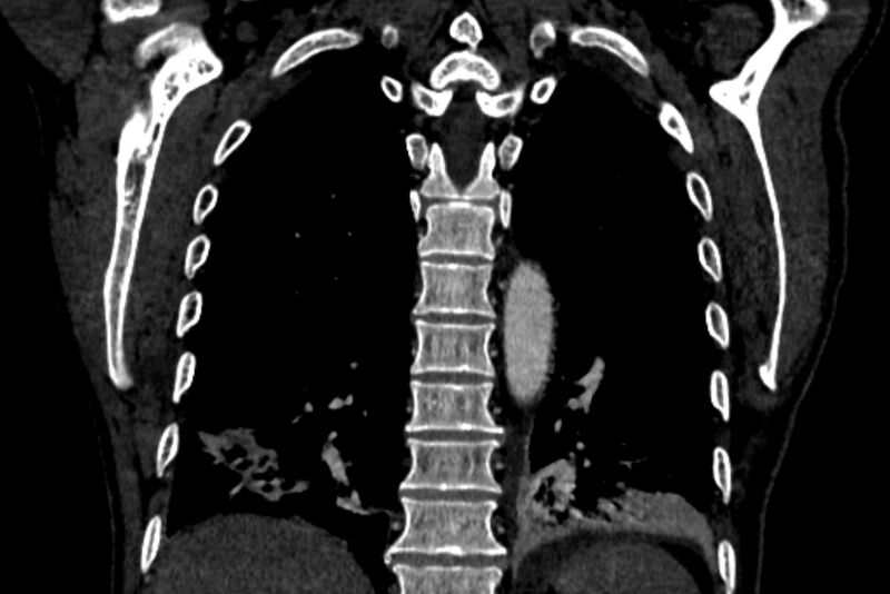 File:Chronic pulmonary embolism with bubbly consolidation (Radiopaedia 91248-108850 B 110).jpg