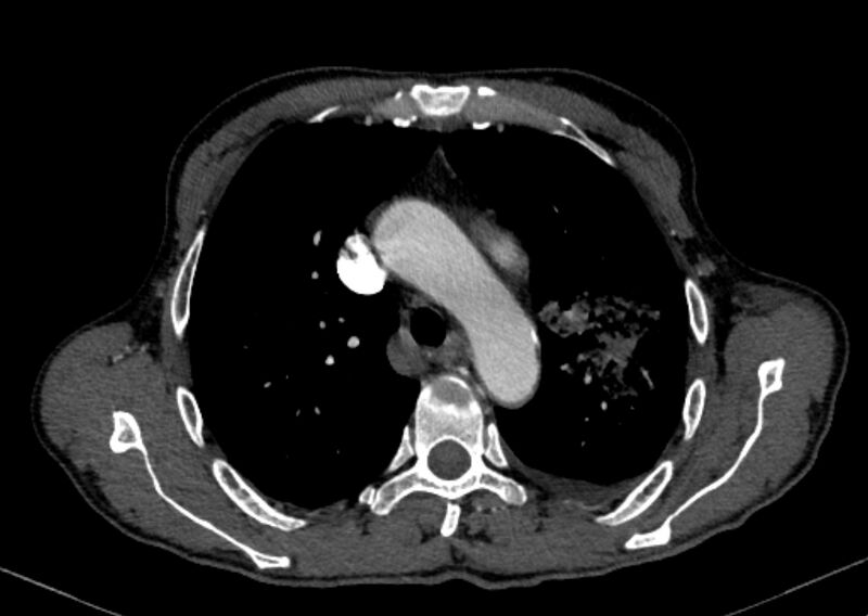 File:Chronic pulmonary embolism with bubbly consolidation (Radiopaedia 91248-108850 C+ arterial phase 40).jpg