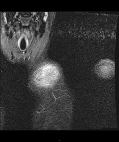 File:Chronic reactive multifocal osteomyelitis (CRMO) - clavicle (Radiopaedia 56406-63071 Coronal STIR 12).jpg
