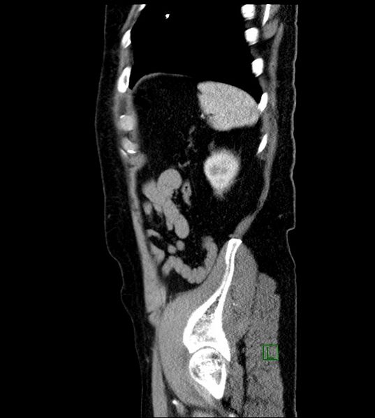 File:Clear cell renal cell carcinoma (Radiopaedia 85006-100539 E 10).jpg