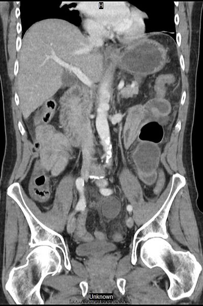 File:Closed loop bowel obstruction and ischemia (Radiopaedia 86959-103180 B 21).jpg