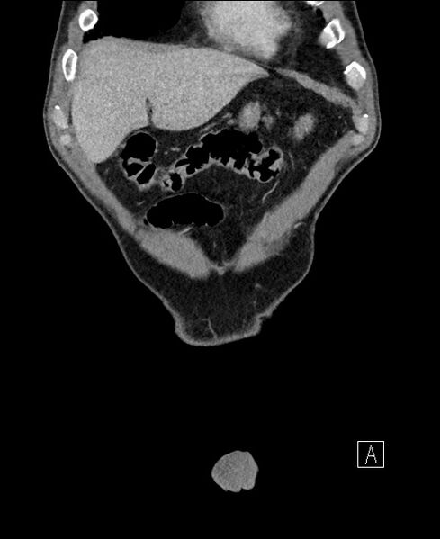 File:Closed loop small bowel obstruction - internal hernia (Radiopaedia 57806-64778 A 16).jpg