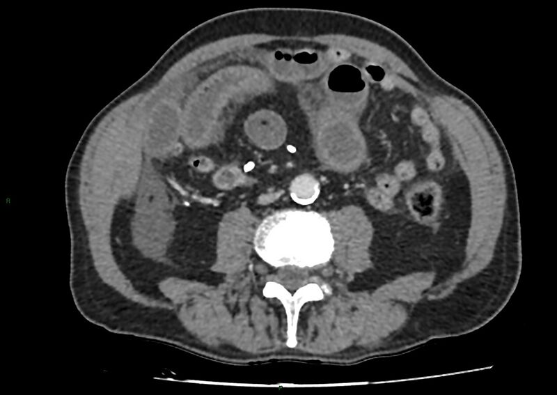 File:Closed loop small bowel obstruction with ischemia (Radiopaedia 84180-99456 A 64).jpg