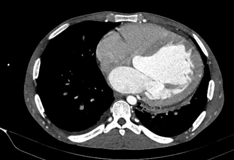 File:Coarctation of aorta with aortic valve stenosis (Radiopaedia 70463-80574 A 144).jpg