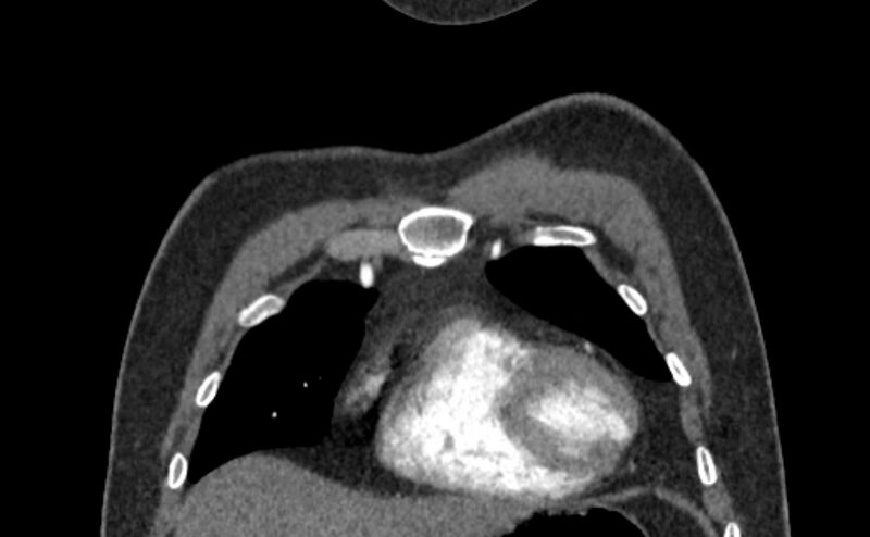 File:Coarctation of the aorta (Radiopaedia 53363-59343 C 10).jpg