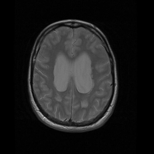 File:Colloid cyst with hydrocephalus (Radiopaedia 9373-10065 Axial PD 14).jpg