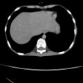 Colocolic fistula - Crohn disease (Radiopaedia 57063-63955 A 2).jpg