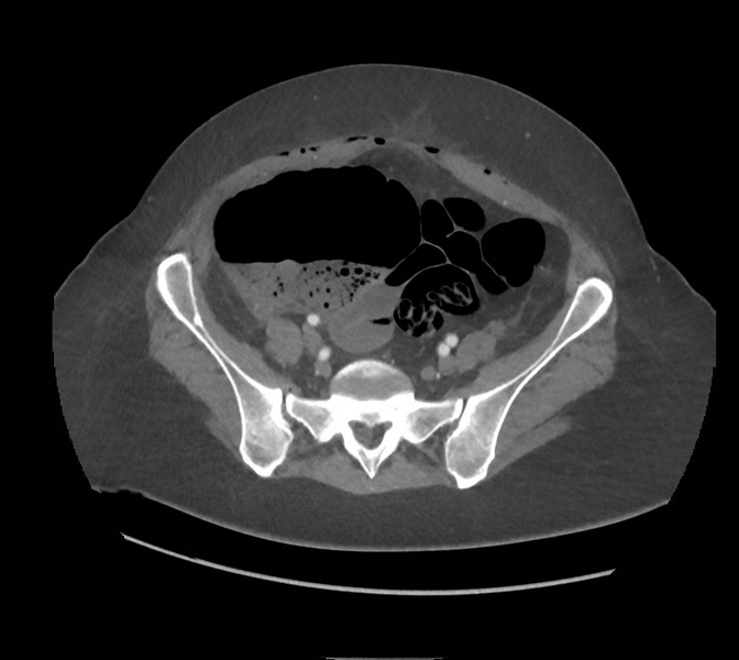 File:Colonic pseudo-obstruction (Radiopaedia 79752-92980 A 140).png