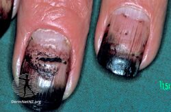 Nail colour changes due to dithranol