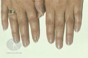Minocycline induced blue nails (DermNet NZ blue-nails-0).jpg