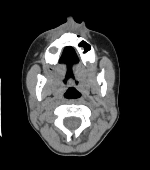 File:Nasoorbitoethmoid fracture (Radiopaedia 90044-107205 Axial non-contrast 94).jpg